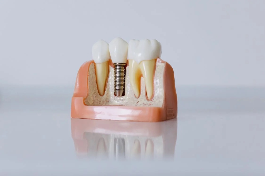Will Health Insurance Cover Dental Implants?